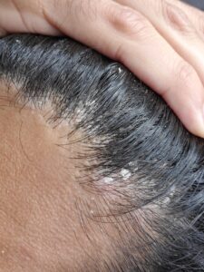 dry scalp
