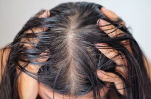 oily scalp