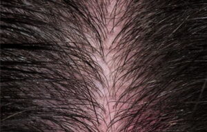 sensitive scalp